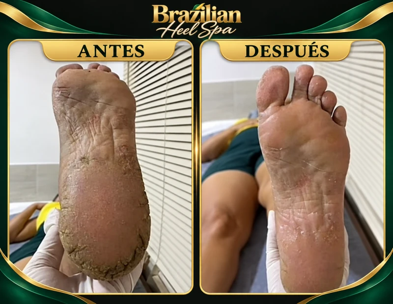 Comparación de la planta del pie antes y después